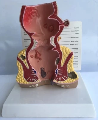 Anatomical model of appendix and cecum Medical teaching Human anorectal pathological | Канцтовары для офиса и дома