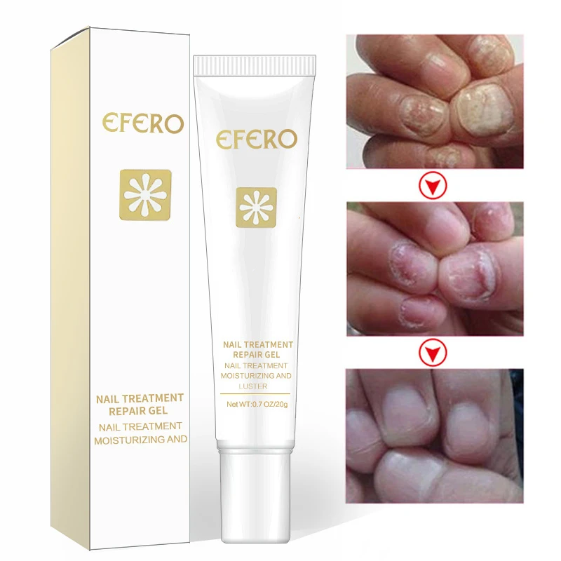 Отбеливающая эссенция для ухода за ногтями 1 шт. средство удаления грибка на