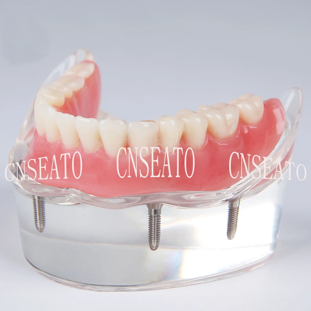 1 шт. стоматологический имплантат восстановление демонстрационная модель зубов M