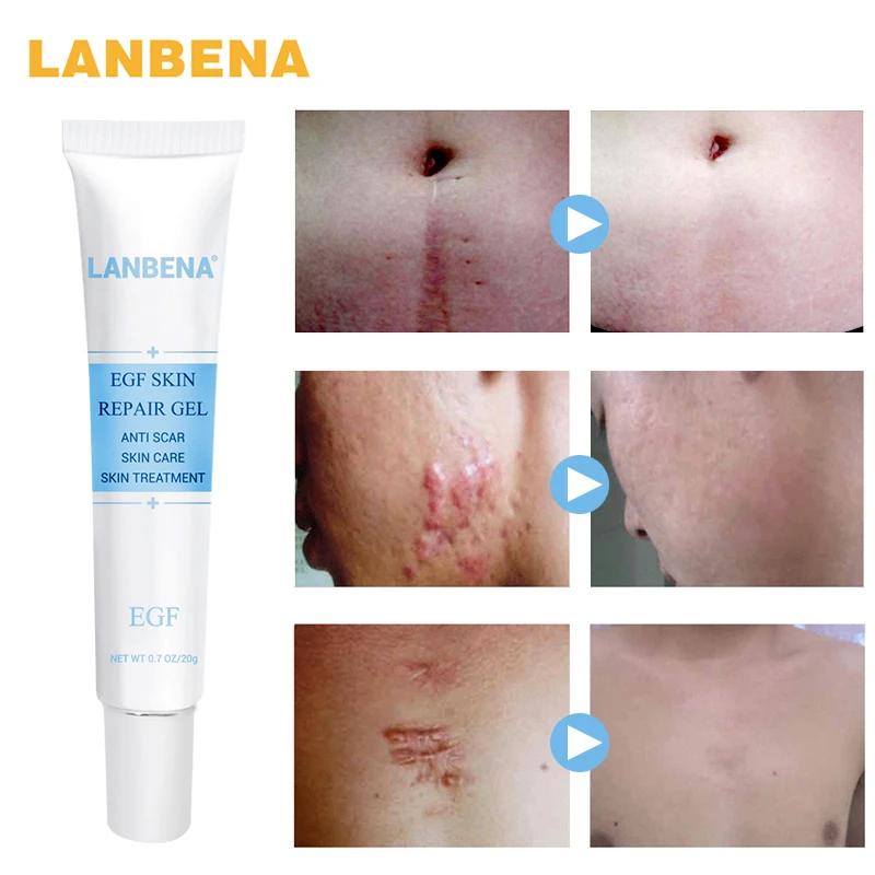 LANBENA Hyaluronic Acid EGF Anti Acne Against Black Dots Cream Scar Removal Facial BlackHead Repair Skin Care Treatment | Красота и