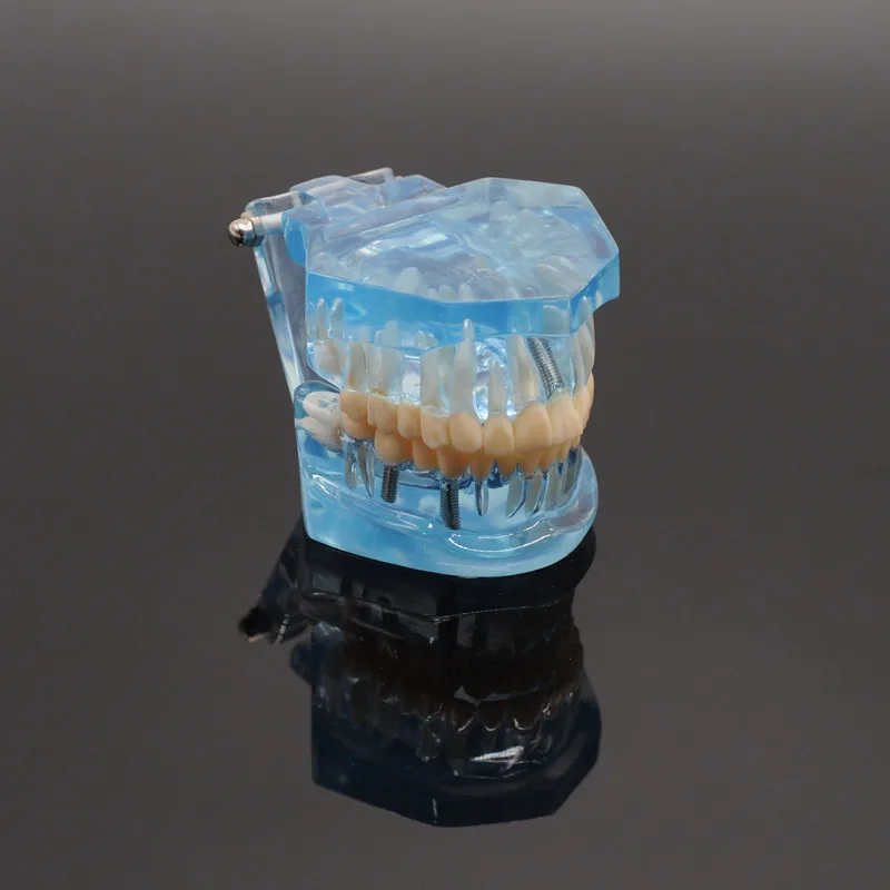 

Модель зубов для изучения зубов, модель для изучения патологии для взрослых, кариес, стоматологическая лаборатория, клиника