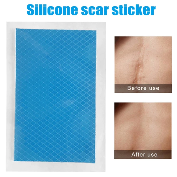 

Silicone Scar Therapy Sticker Remove Trauma Burn Silicon Patch Reusable Acne Gel Skin Repair EK-New