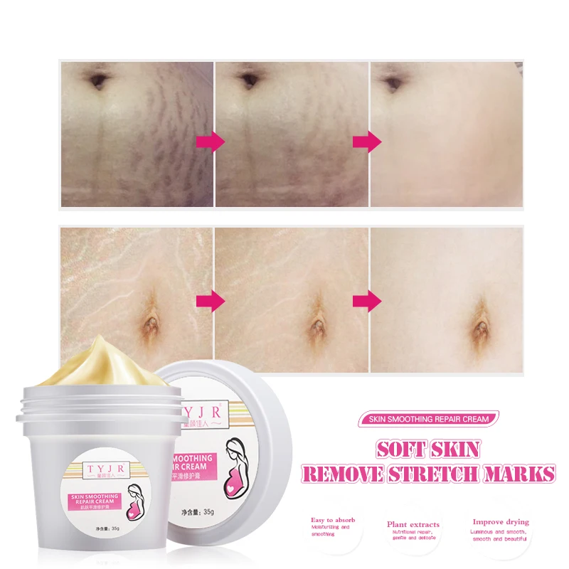 Отбеливающий крем TYJR для кожи Крем Для Удаления растяжек рубцов послеродового