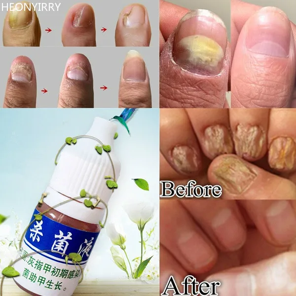 Инструмент для ухода за ногами Ingrown коррекция ногтей носочки кусачки для стрижки кусачки для удаления грязи из мертвой кожи+ Paronychia Podiatry педикюр