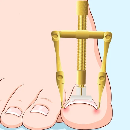 Инструмент для коррекции ногтей на пальцах ног, оборудование, фиксатор, инструменты для восстановления ногтей на пальцах ног, Ортез для ног... от AliExpress WW