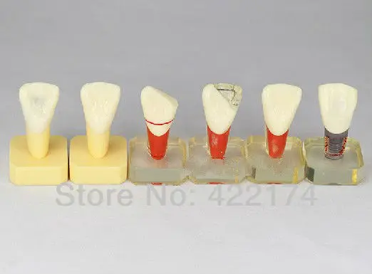 Бесплатная доставка модель стоматологической протезы для коррекции зубов