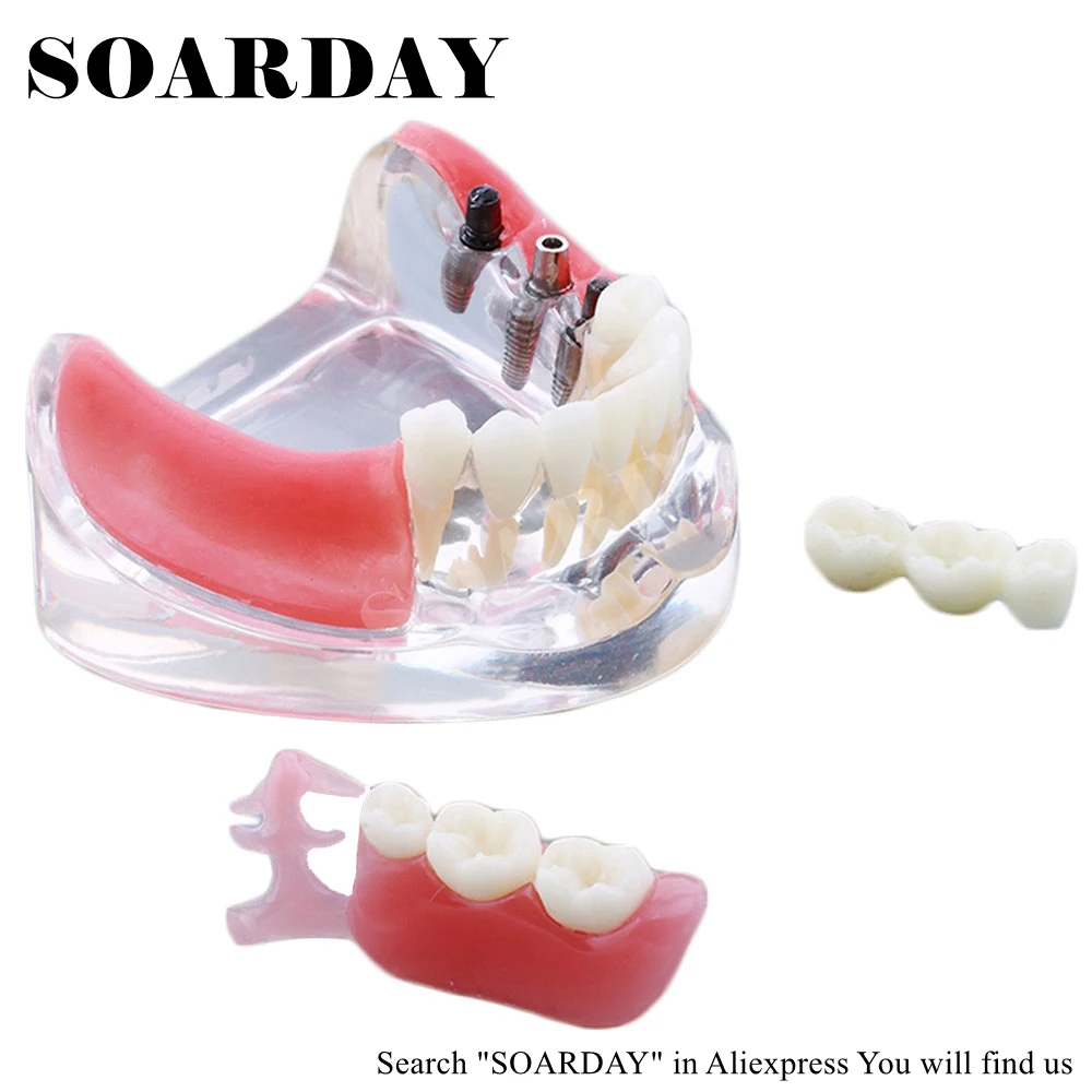Модель имплантации и коррекции зубов SOARDAY модель анатомической анатомии