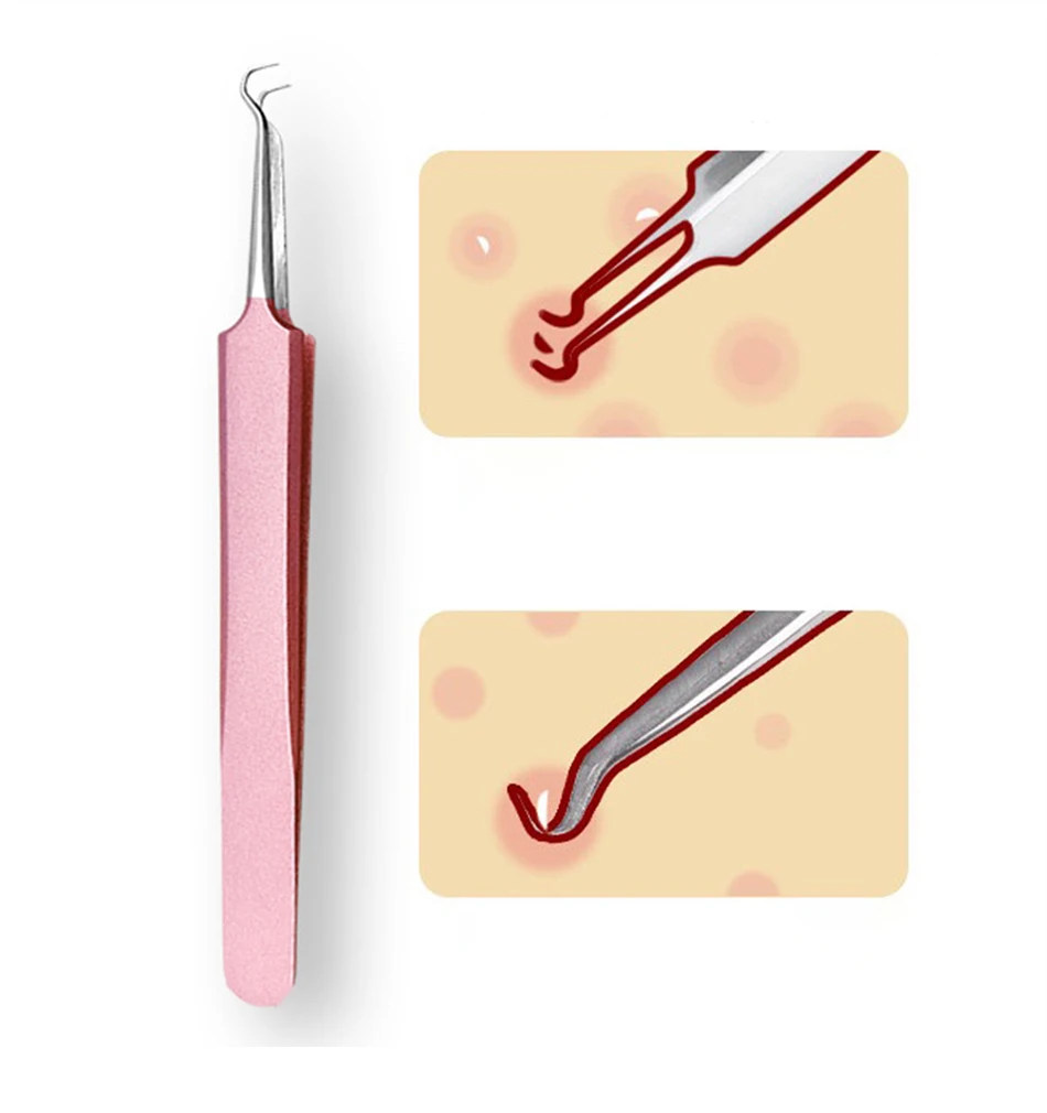 Blue Pink 1PC Acne Comedo Stainless Steel Needle Professional Comedone Blackhead Remover Tweezer For Face Skin Care Tool