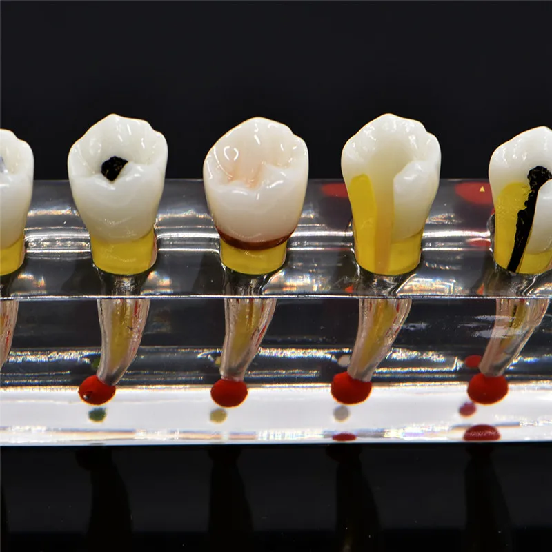 Dental Pulp Restoration Pathological Model with Detachable teeth Premolar caries crown pulp cavity filling | Красота и здоровье