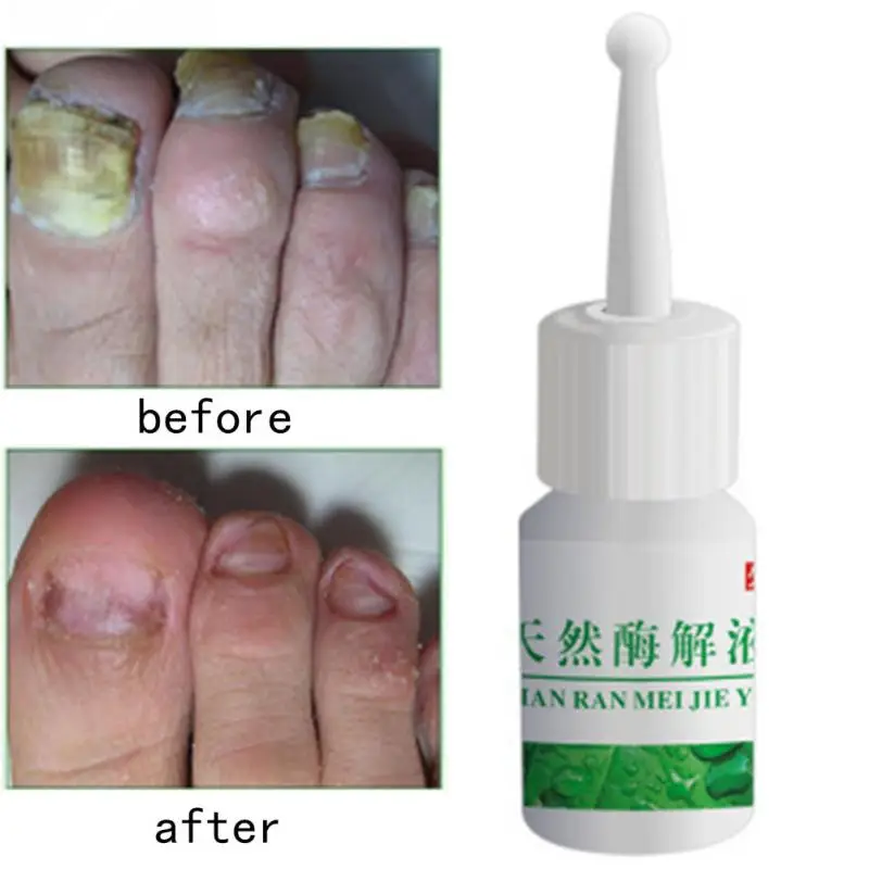 Новый Уход за ногтями травяные ногтей ремонт крем анти грибковые китайская