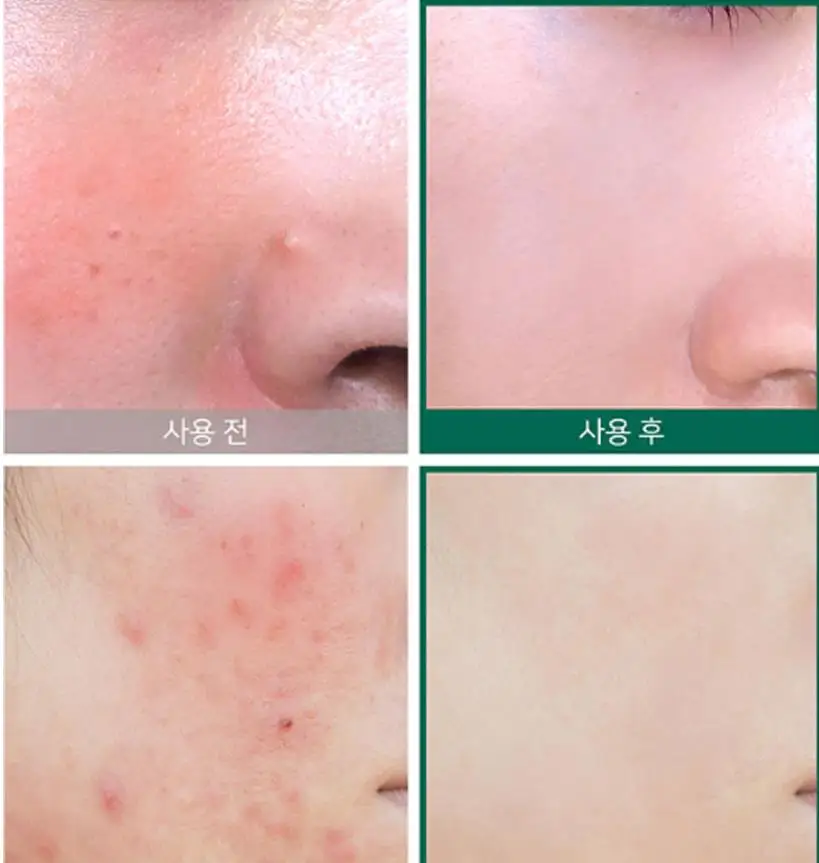 SOME BY MI AHA BHA PHA 30 Days Miracle Starer Kit Edition Сыворотка для лица лечение акне крем для удаления черных точек кожного сала тонер