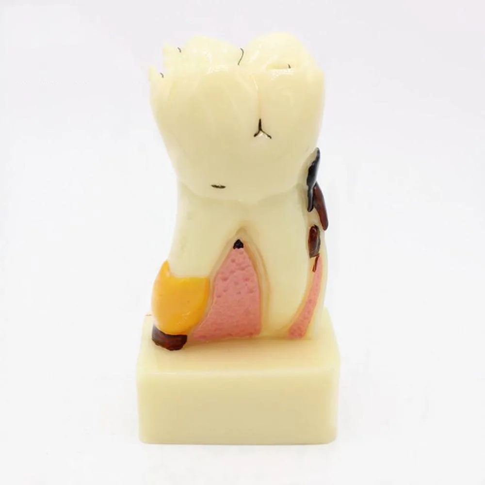 Модель анатомии для выполнения обычных патологий зубов модель кариес