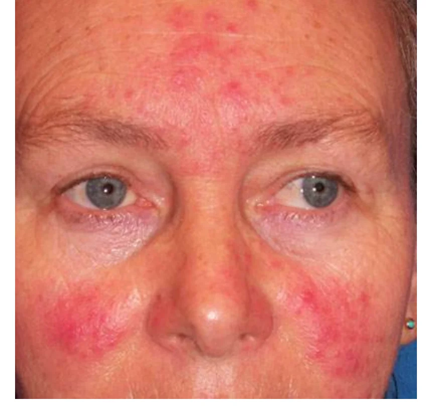 

Rosacea cream Red nose ointment remove blackhead acne cream Skin care herbal anti acne and mite acne rosacea treat Shrink Pores