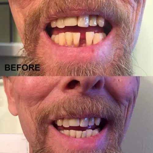 Carillas dentales para dientes postizos carillas de sonrisa carillas extraíbles en los dientes sonrisa temporal Kit de fijación de dientes Color Natural