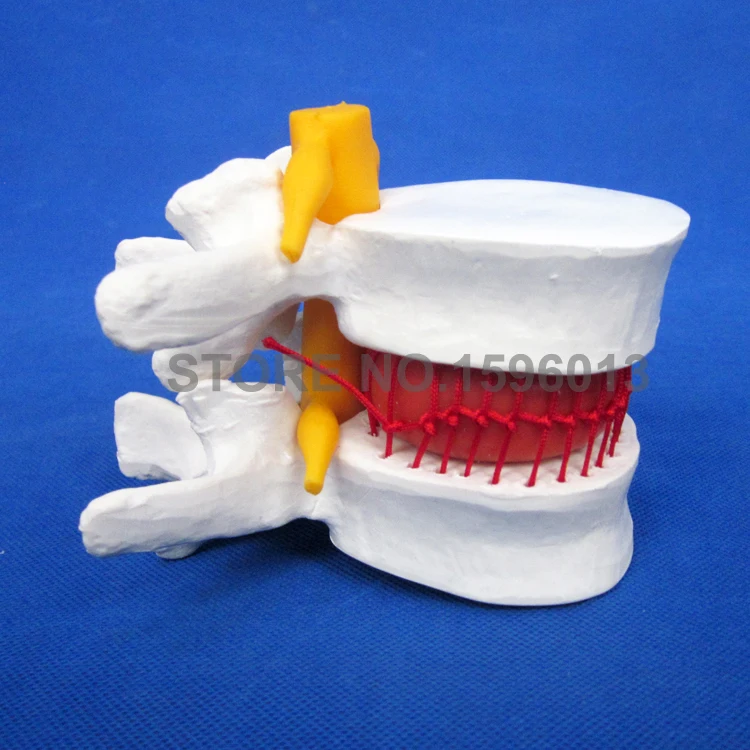 Усиленная поясничная модель позвонка грыжа модель диска