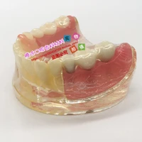 human model dental model comprehensive pathology detachable implant repair crystal free shipping