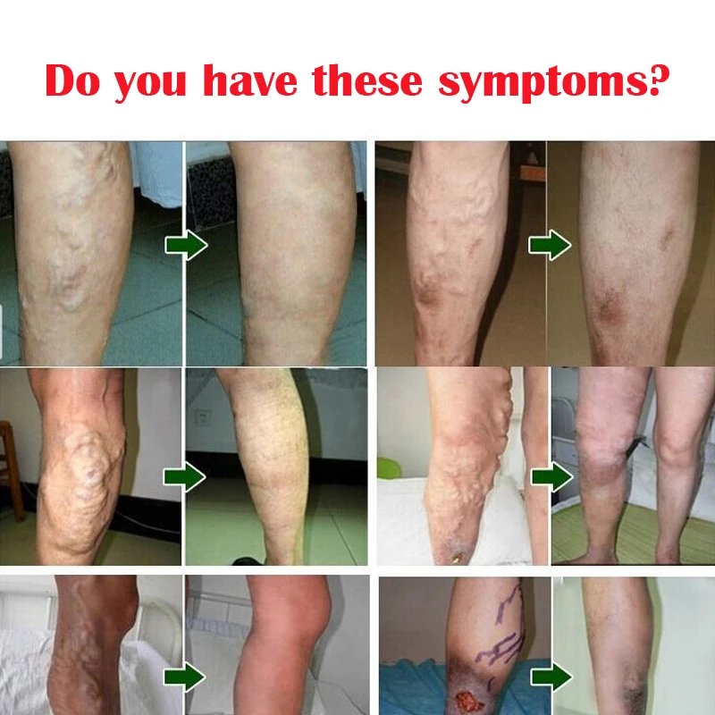 2 шт. варикозный медицинский лекарт против варикозного расшрения вен крем для