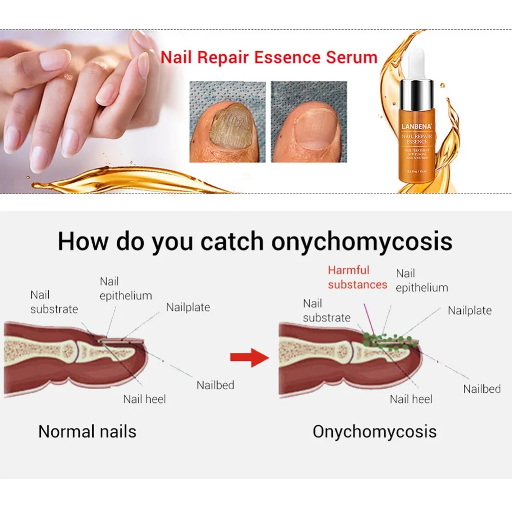 Гель LANBENA для ухода за ногтями лечение грибковых ногтей Удаление онихомикоза