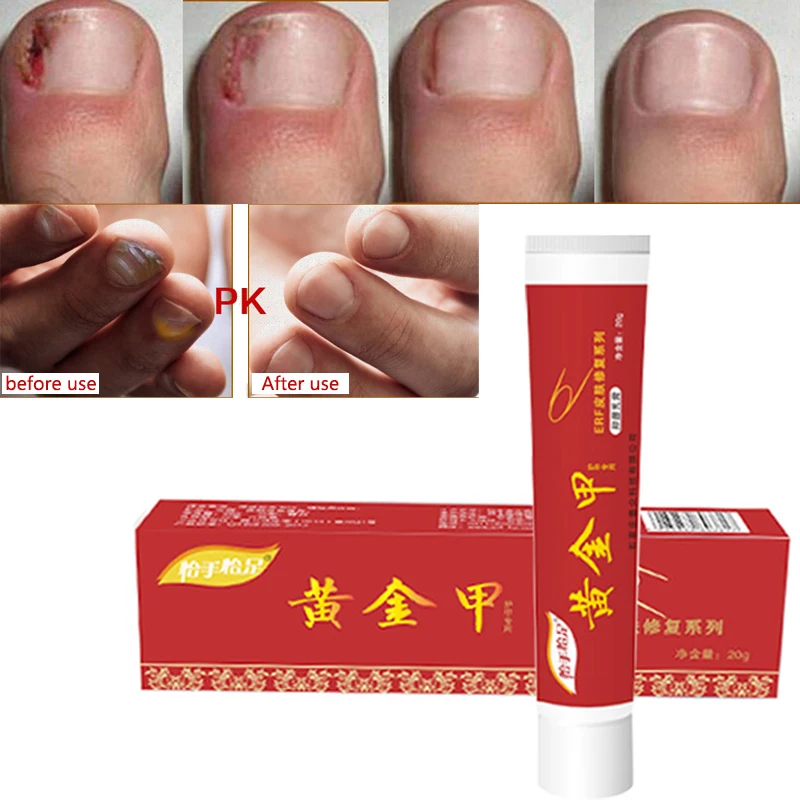 20 г Лечение грибка для лечения Ногтей мазь тоэнил онихомикоз борется с