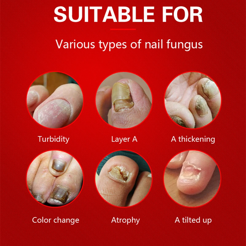 Nail Treatment Care Essence Whitening Removal Gel Fungal Cream | Красота и здоровье