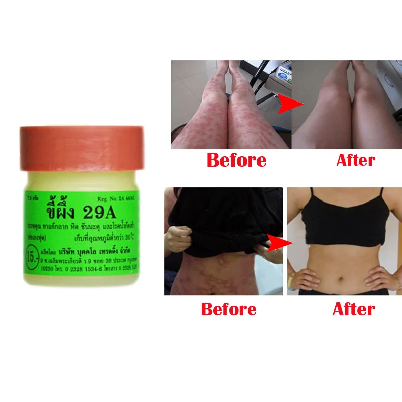 4 шт. профессиональная мазь для лечения псориаза оригинал из Вьетнама ингредиент