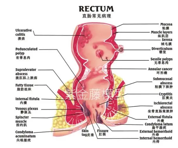 Anatomical model of appendix and cecum Medical teaching Human anorectal pathological | Канцтовары для офиса и дома