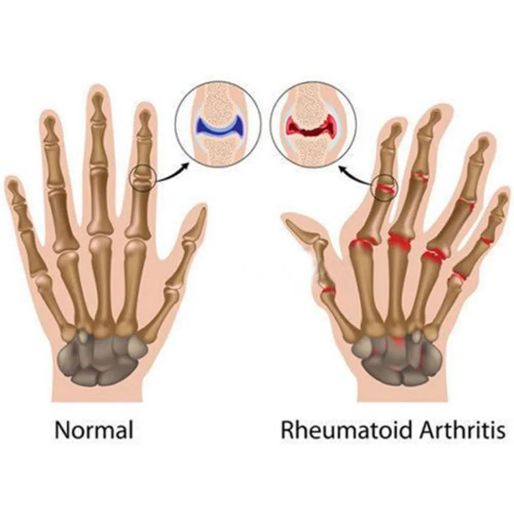 

1 Pair Unisex Arthritis Gloves Copper Fiber Sports Health Half Finger Recovery Gloves Absorb Sweat Breathable Protect Your Hands
