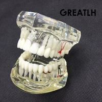 dental implant disease teeth model with restoration bridge tooth dentist for science dental disease teaching study