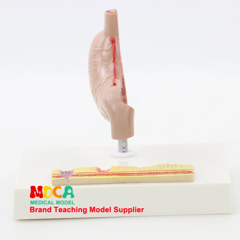 

Pathological gastrointestinal model human gastric lesions teaching aids digestive system medicine teaching MCW008