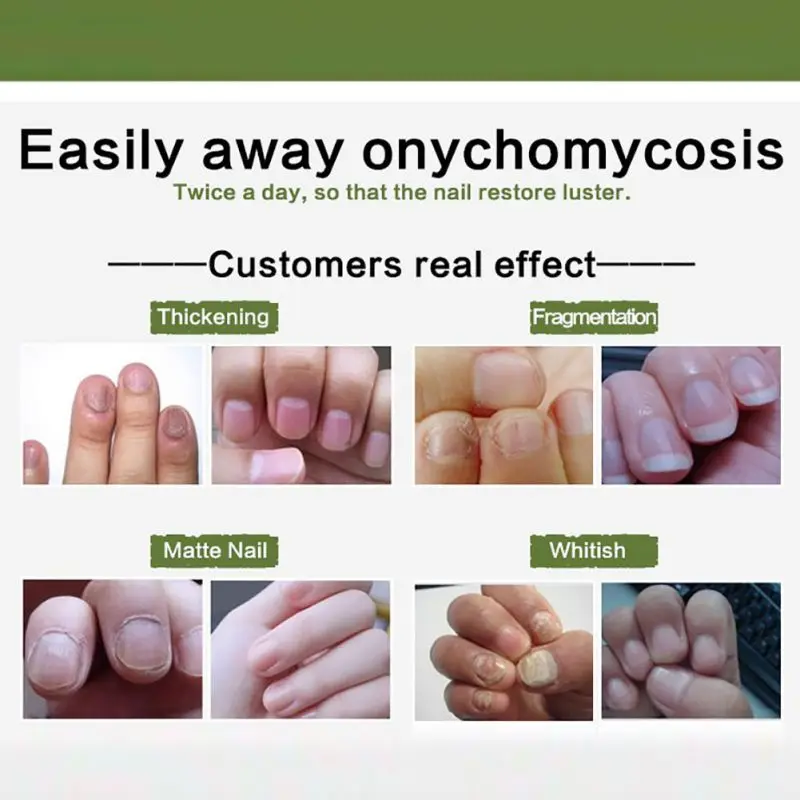 Горячая 30 мл гель для ухода за ногтями грибковое Лечение ногтей эссенция