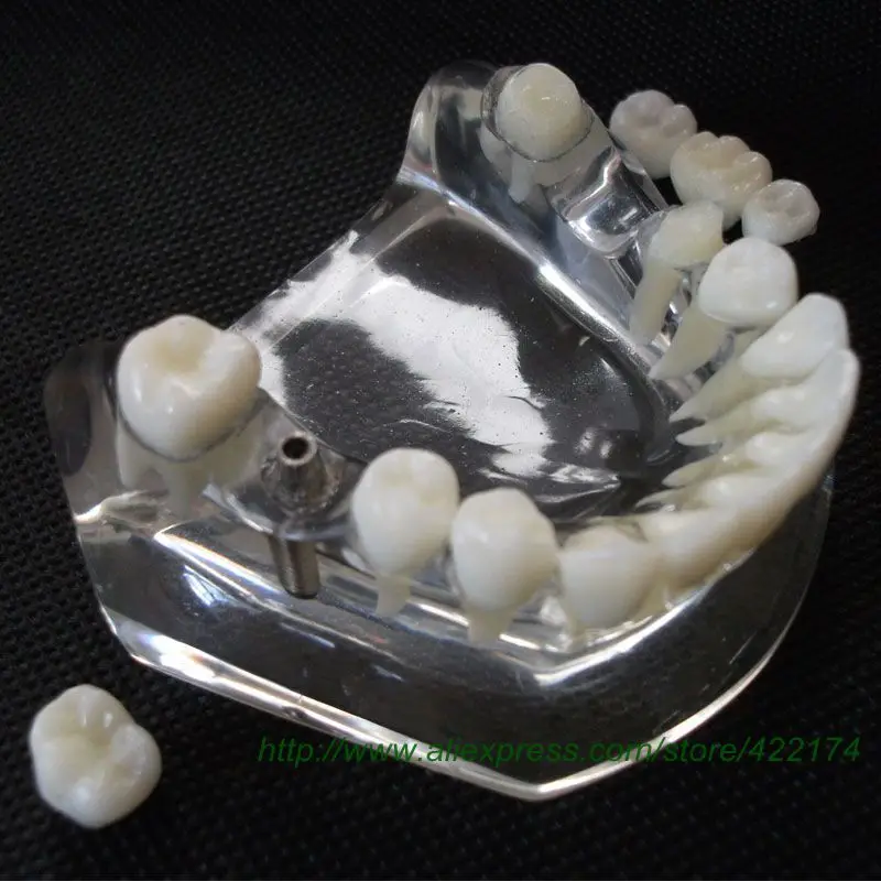 

Free Shipping Implant model with bridge and caries 1 implant and 3 tooth removable odontologia dental tooth teeth model