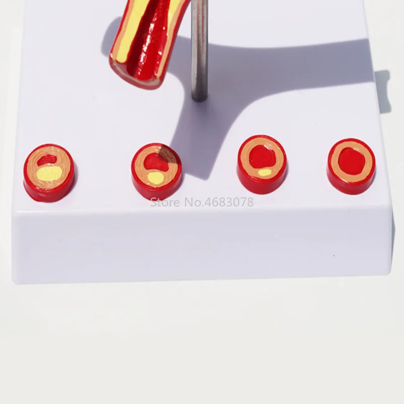 10 кратное увеличение артериального коронарного артеросклероза атеросклероза