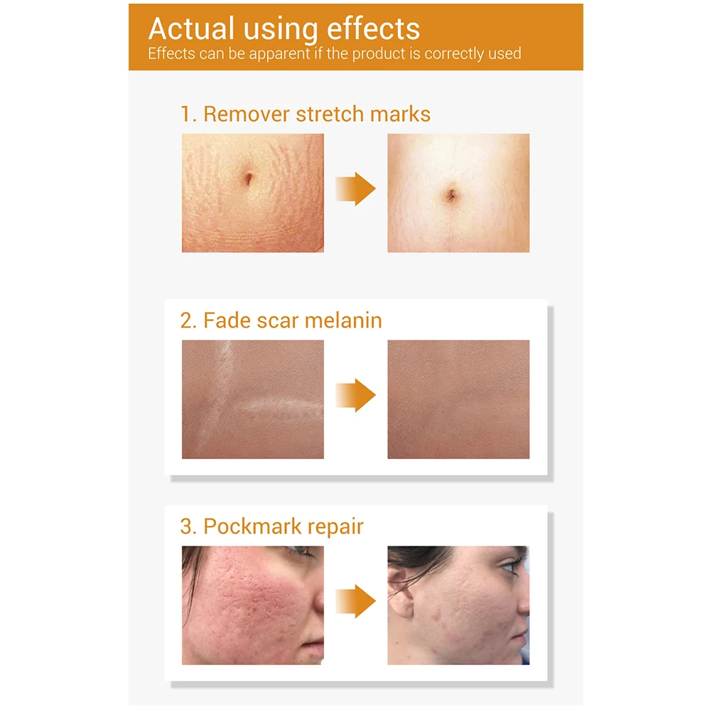 

20ml Acne Scar Remove Serum Acne Treatment Remover Stretch Marks Anti Acne Shrink Pores Blackhead Repair Essence Skin Care