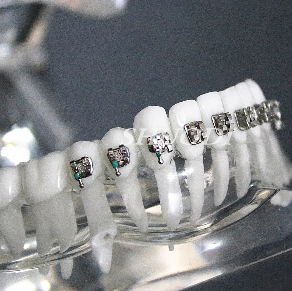 Стоматологическая Ортодонтическая модель для связи с пациентами 4 вида скоб