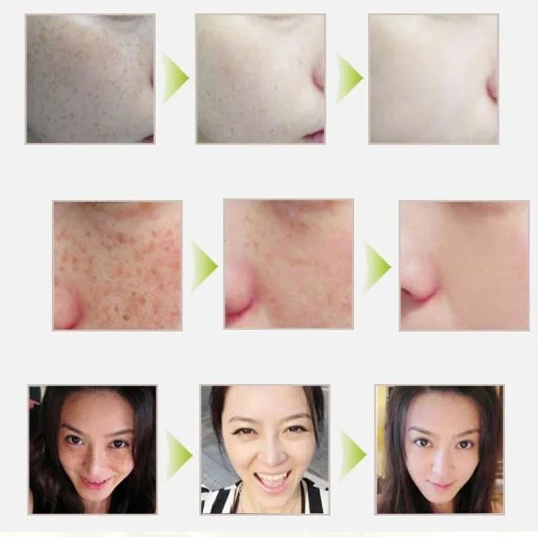 Красота уход за кожей Отбеливающий крем лицом средство для удаления темных пятен