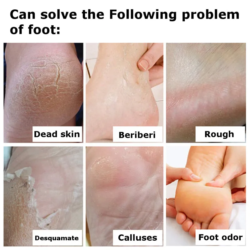 Китайская медицина крем для массажа пятки ног анти сухая трещина избавляет от
