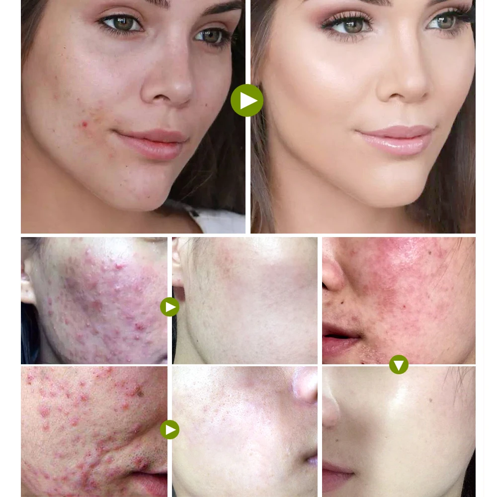 

VIBRANT GLAMOUR Acne Cream Face Cream Set Remove Scar Acne Treatment Anti Acne Marks Skin Care Plant Extract Buy 3 Get 1 Gift