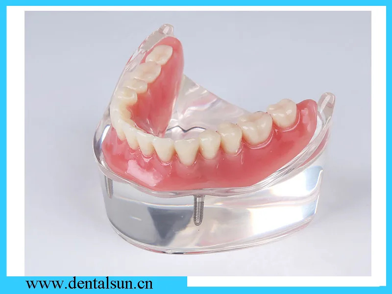 Приспособления для зубных имплантатов и мостовой абутмент зубов/протезная