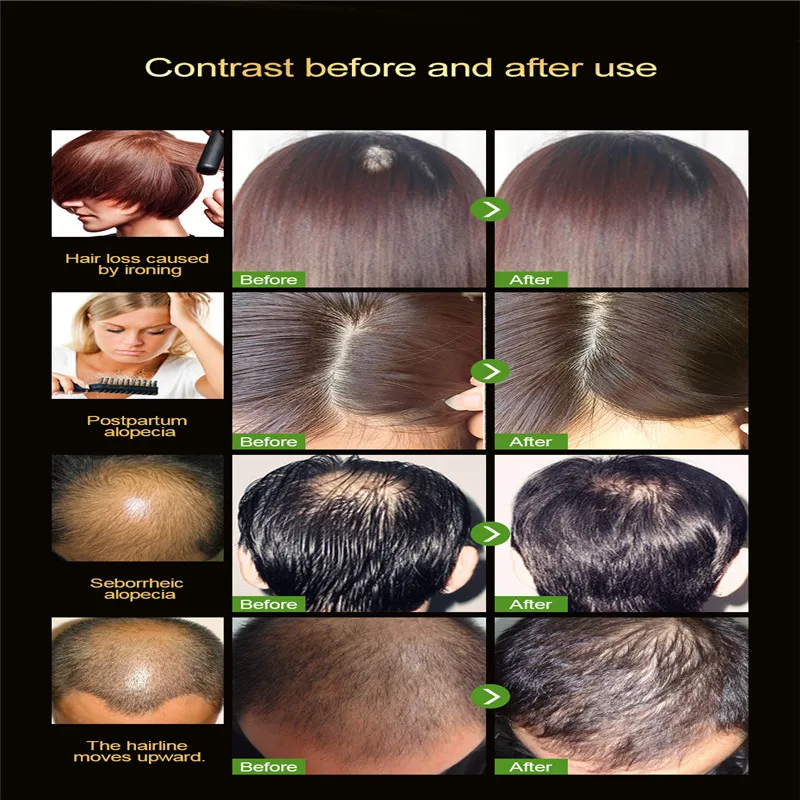 20 мл Уход за волосами эссенция для роста жидкие волосы лечение естественной