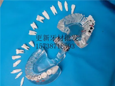 

Dental pathology model Crystal clear Removable 16 teeth free shipping