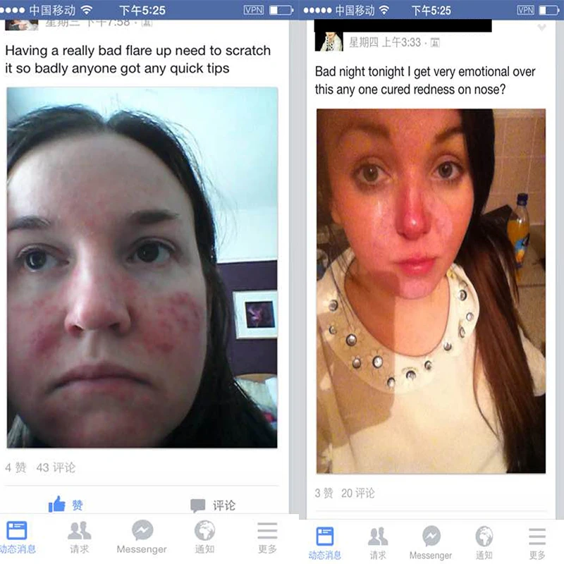 Крем мазь для удаления угрей и акне крем ухода за кожей травяные антиакне клещи