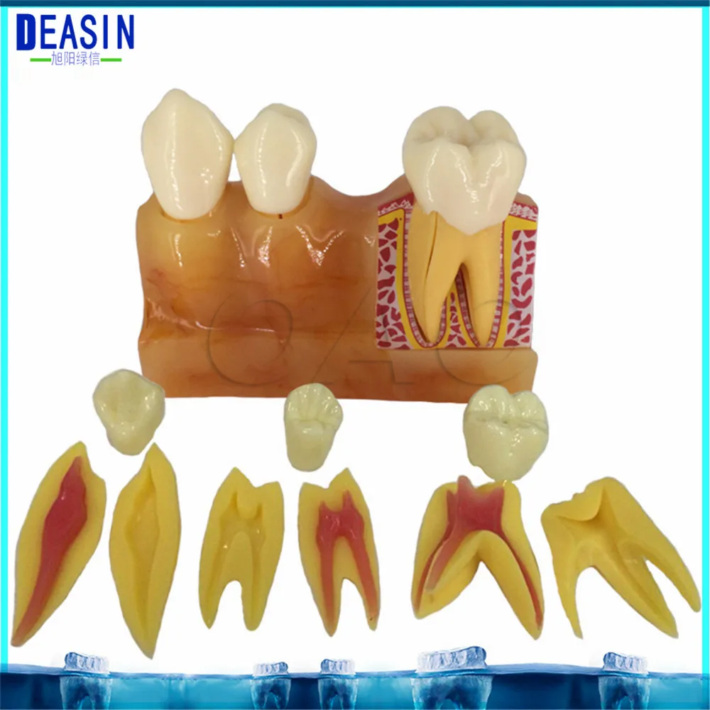 4 times tooth decomposition model Teaching explanation Dental pulp anatomic oral model Tooth removable