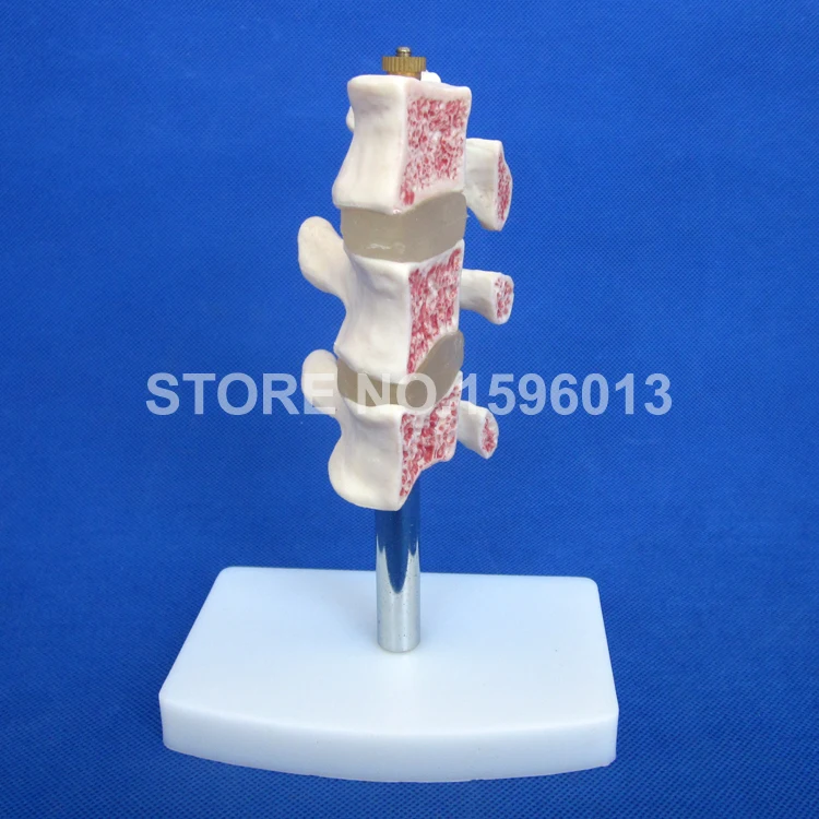 Горячая продвинутая модель остеопороза позвоночника повреждения в модели