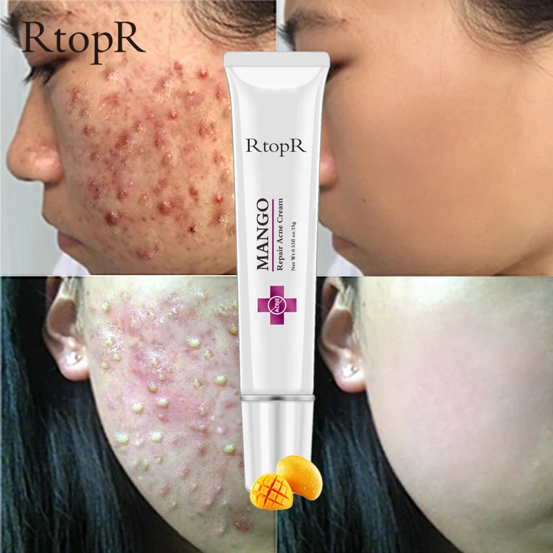 RtopR Repair Acne крем увлажняющий против акне пятна лечение шрамов от угрей сужающийся