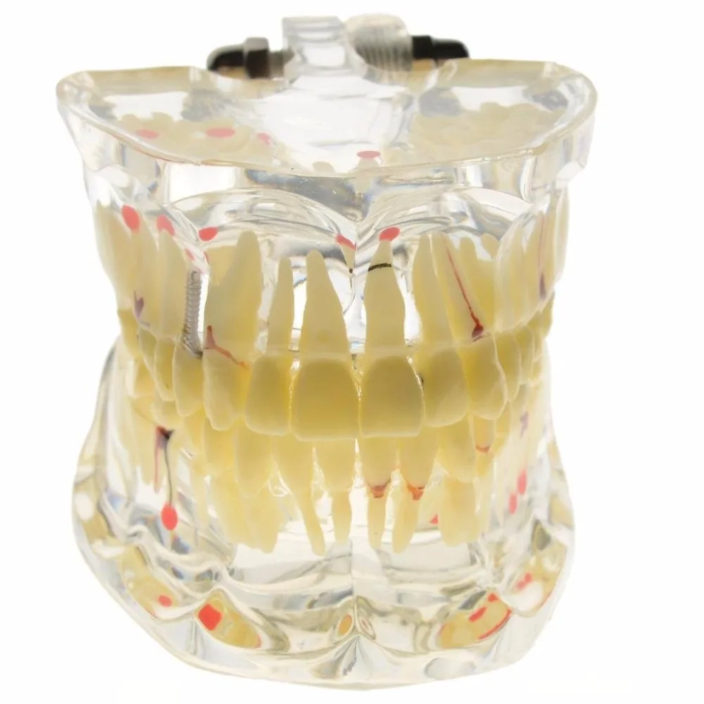 1 шт. стоматологические патологии взрослого модель Dental Implant болезни зубы модель Стоматолог для медицинской науки преподавания исследование стоматология инструменты