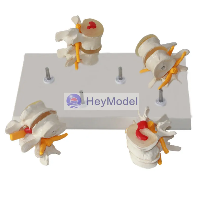 Четырехступенчатая поясничная модель позвоночника HeyModel костные шпоры