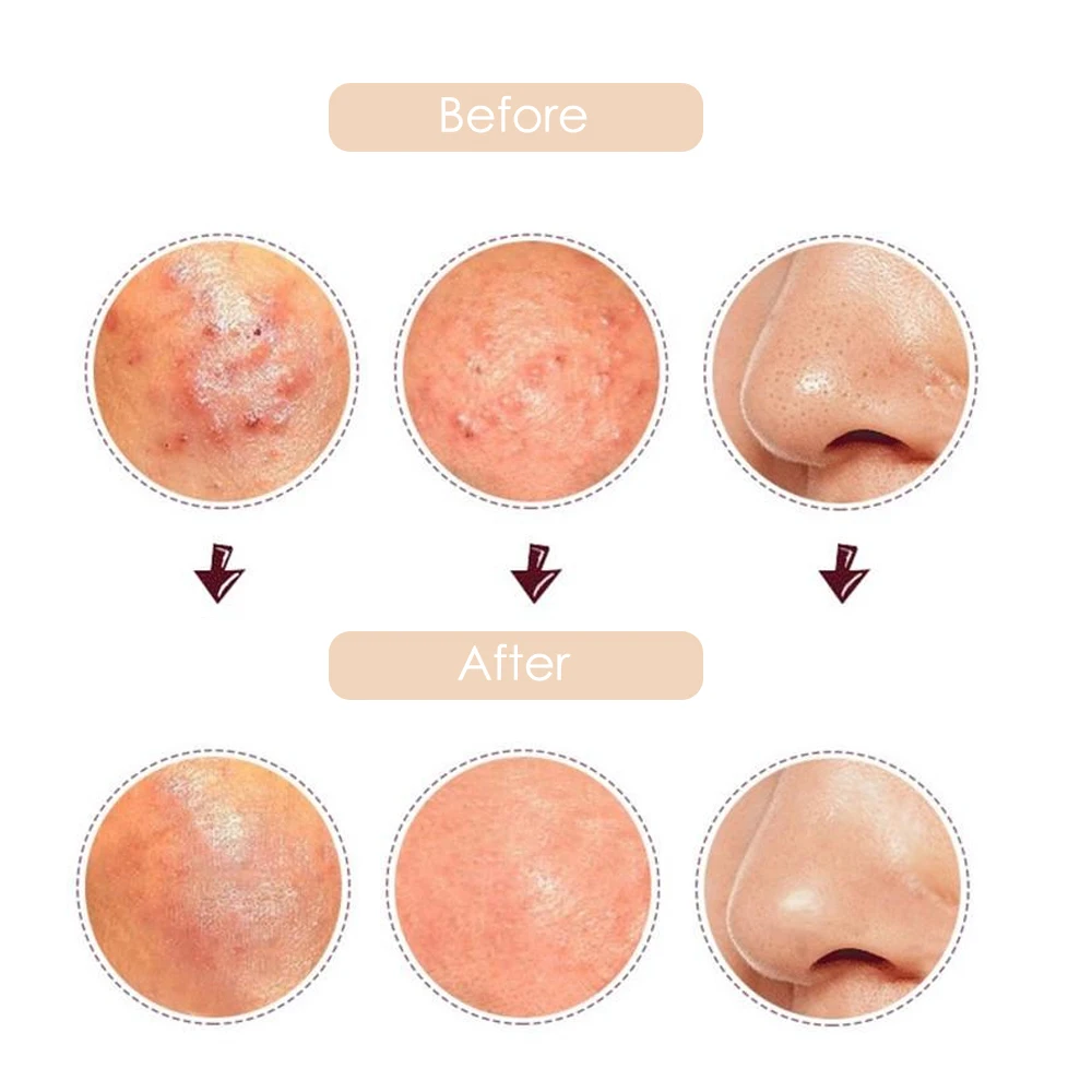 4 шт. иглы для удаления акне и черных пятен | Красота здоровье