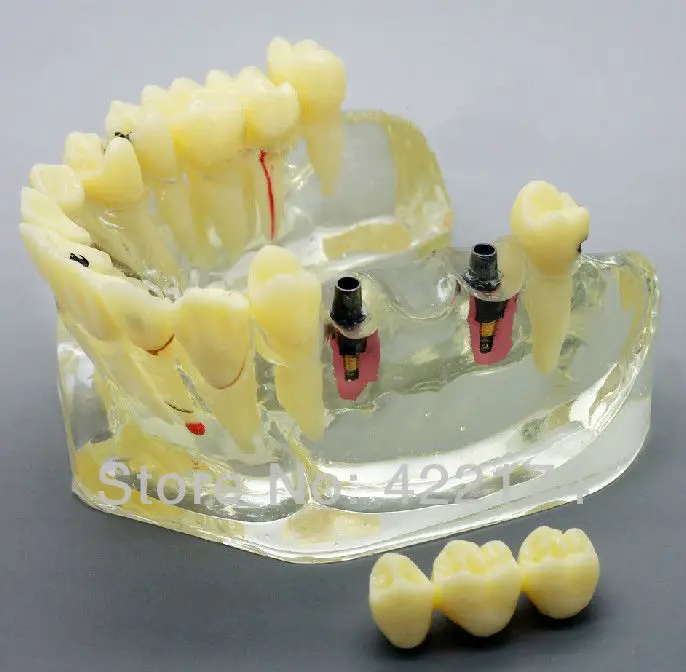 Бесплатная доставка протез для коррекции зубов модель исследования