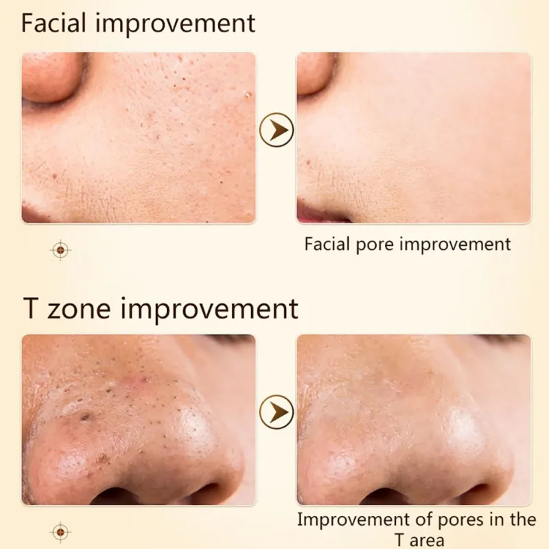 Жидкость для лечения акне 30 мл|Сыворотка| |