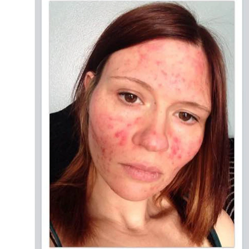 Крем мазь для удаления угрей и акне крем ухода за кожей травяные антиакне клещи